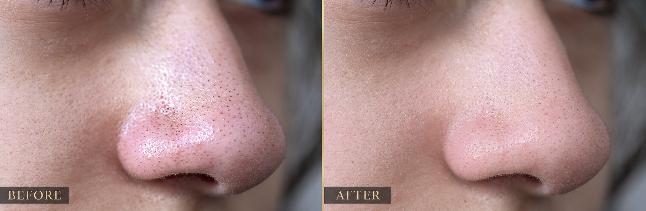 Side-by-side illustrative comparison of the same nose before and after, showing clearer-looking pores on the right